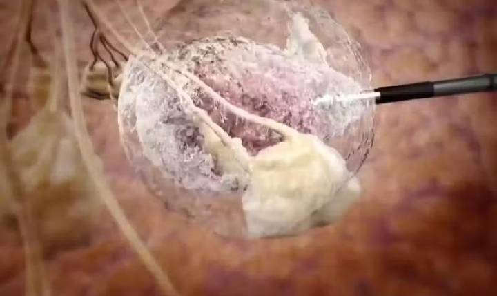 Brasil testa uma nova técnica de combate ao câncer de mama; congelamento