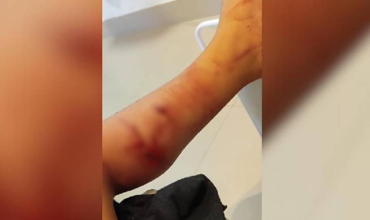 Criança de 3 anos é atacada por cachorro próximo a creche em Ponte Serrada