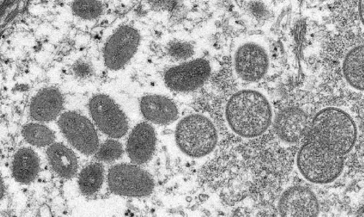 Secretaria Municipal de Saúde confirma mais um caso de varíola dos macacos em SC