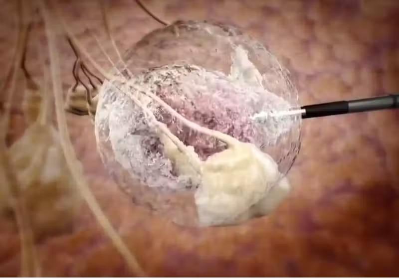 Brasil testa uma nova técnica de combate ao câncer de mama; congelamento