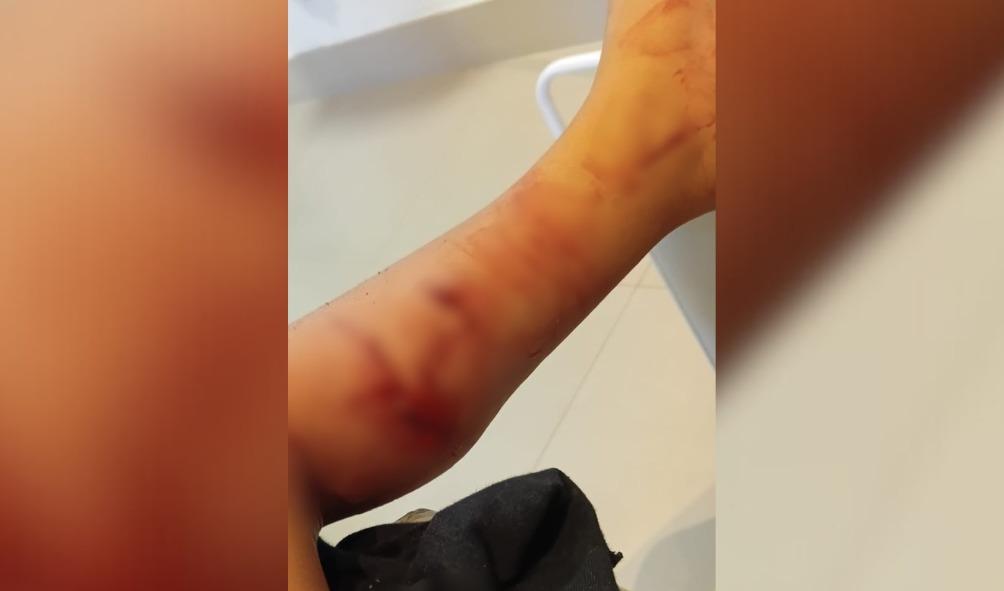 Criança de 3 anos é atacada por cachorro próximo a creche em Ponte Serrada